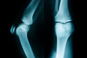 Роботизированное эндопротезирование улучшало точность установки протеза коленного сустава